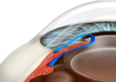 most common type of glaucoma is Primary Open Angle Glaucoma
