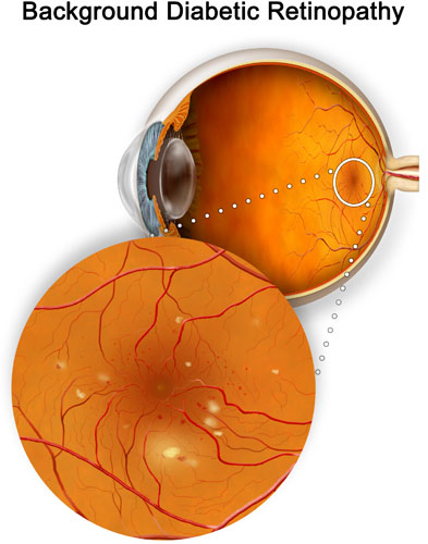 Nonproliferative retinopathy can cause blood vessel damage in the retina
