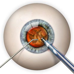 a delicate sophisticated microscopic instrument will be inserted that allows the removal of your cataract using ultrasound.