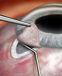 glaucoma surgery may be an option and can include removing a tiny piece of the trabecular meshwork