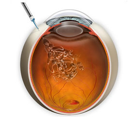 Eylea® and Lucentis® Injections are placed directly into the Vitreous of the eye.