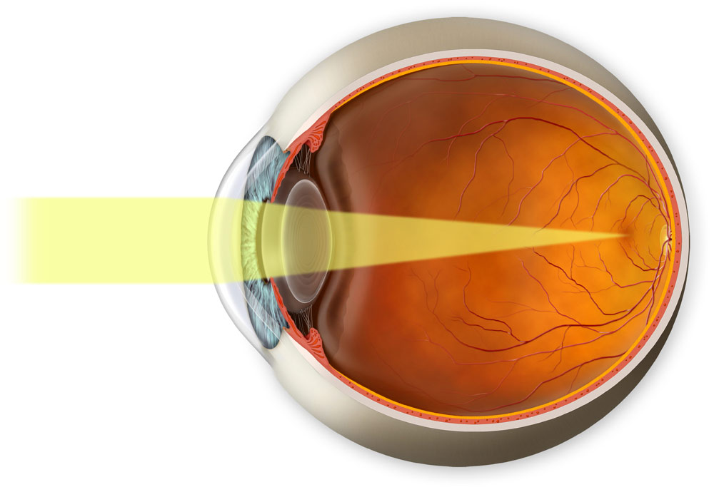The cornea and crystalline lens need to be clear for good vision
