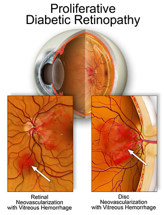 Profilferative Retinopathy is the most severe stafe of diabetic retinopathy
