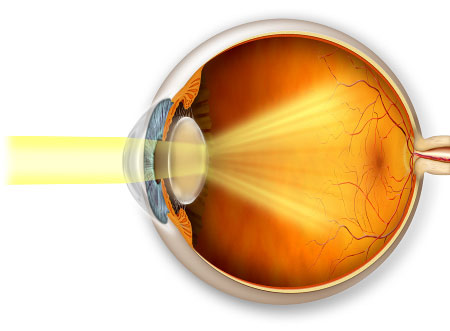 Cataracts can impact vision