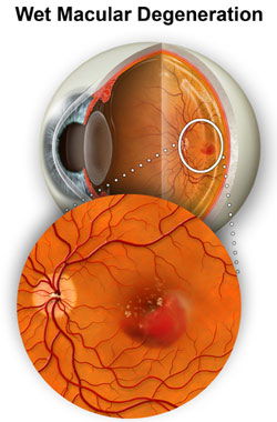 Wet Macular Degeneration is characterized by an abnormal growth of new blood vessels under the retina