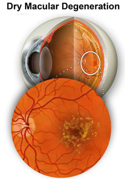 In dry macular degeneration small, yellow colored deposits between the retinal layers, which are called Drusen