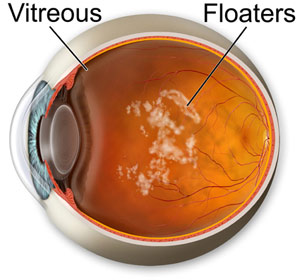 strands of Vitreous can actually cast shadows on the retina and creates the appearance of floaters
