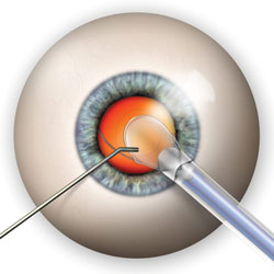 After the cataract has been removed, your surgeon will insert a new, crystal clear permanent intraocular lens implant (IOL) into your eye.