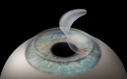 the flap of corneal tissue is placed back in its original position