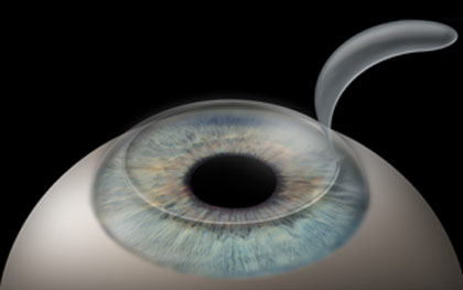 During LASIK a thin flap of corneal tissue is created and lifted upward