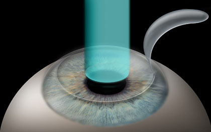 during LASIK laser energy is applied to the corneal tissue