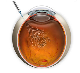 Eylea® and Lucentis® Injections are placed directly into the Vitreous of the eye.