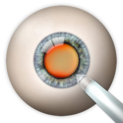 At the beginning of the surgery, Dr. Buck will place a very small incision at the outermost edge of your cornea.